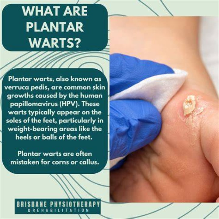 Are plantar warts HPV?