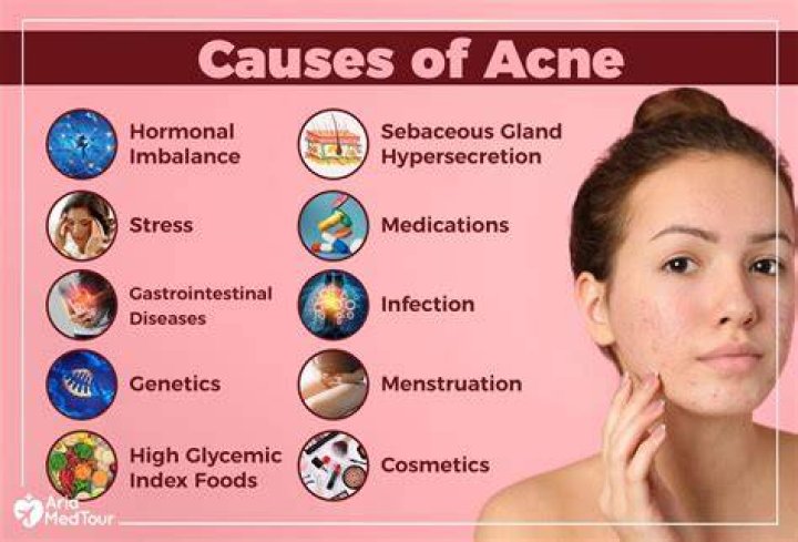 What deficiency can cause acne?
