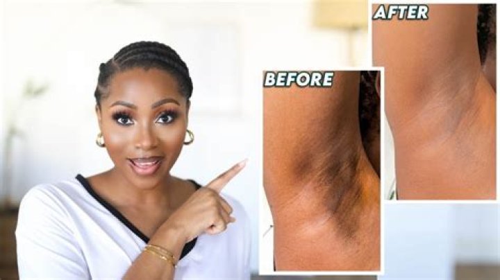 Why do I have black armpits?